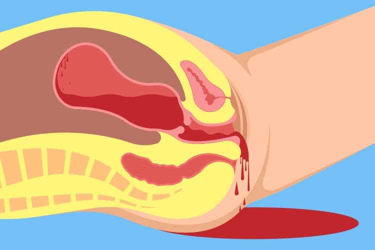 Postpartum Haemorrhage - Causes And Treatment - Delivery And Postpartum - 2021 Postpartum Haemorrhage Symptoms