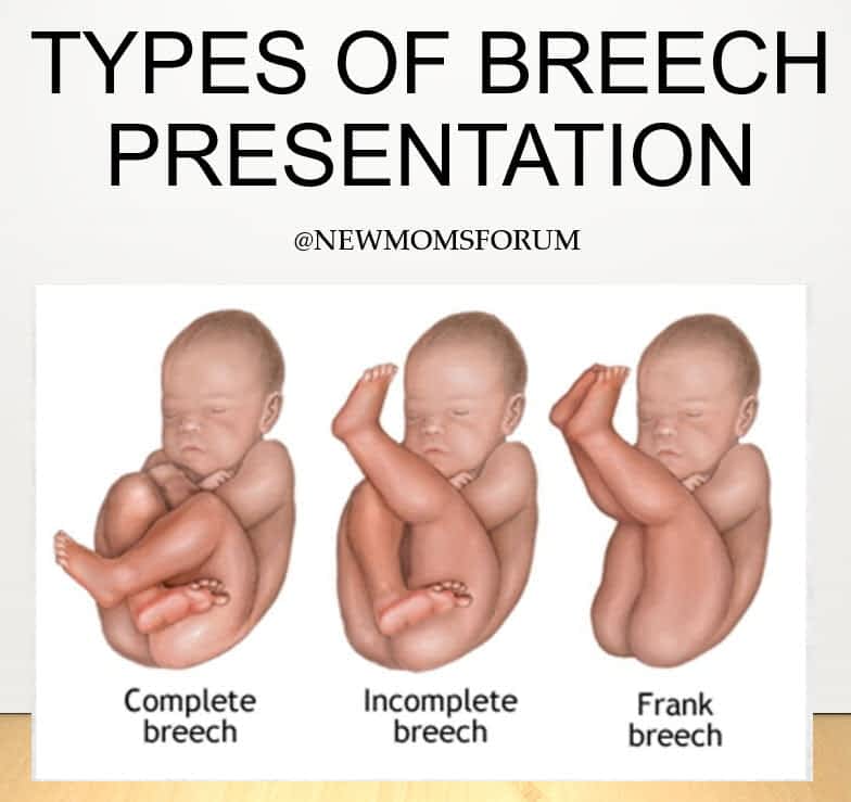 meaning of breech presentation in hindi