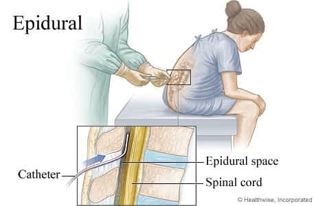 epidural or spinal anesthesia
