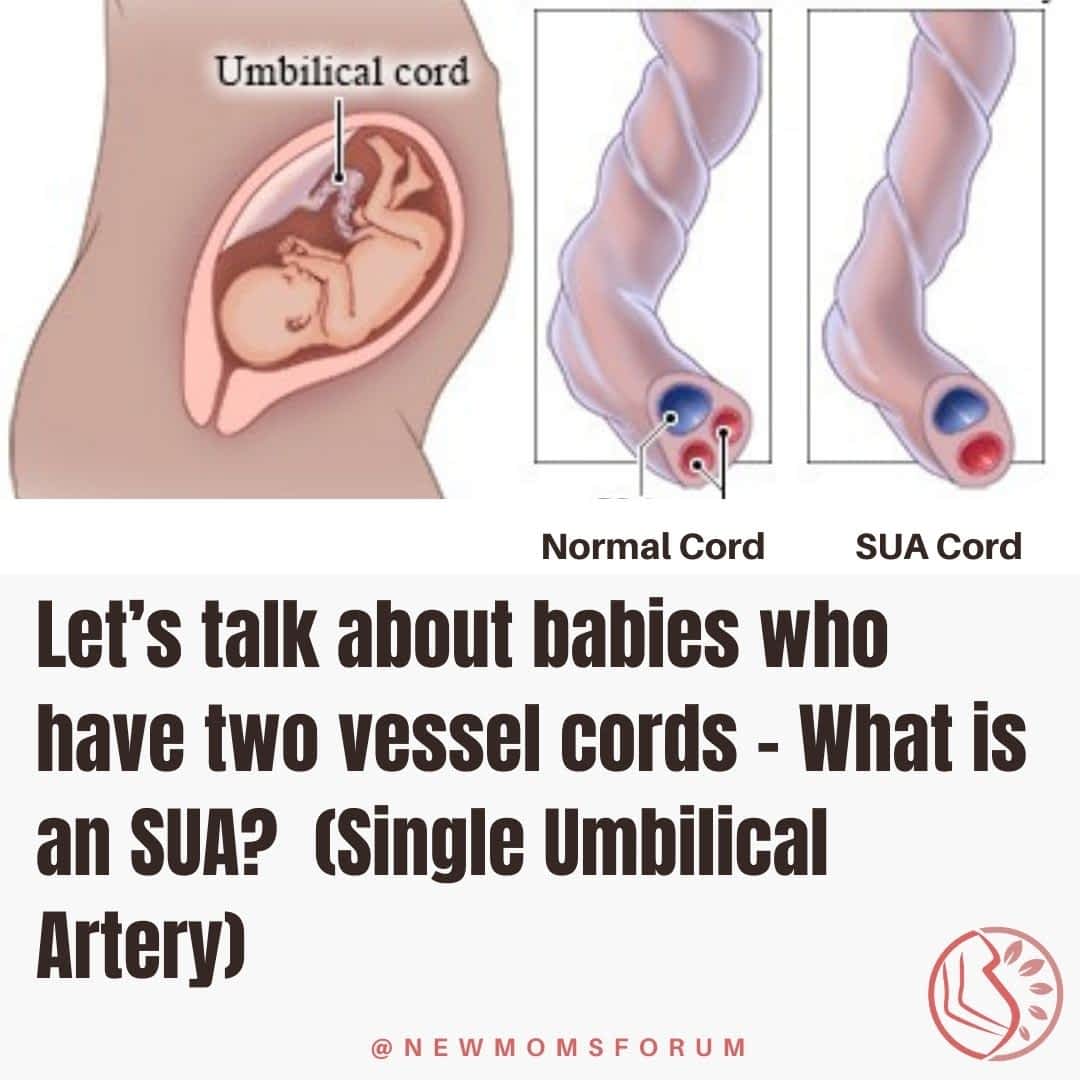 Two Vessel Cords Or Single Umbilical Artery (Sua) - Pregnancy - 2021 Sua - Single Umbilical Artery - Babies Who Have Two Vessel Cords