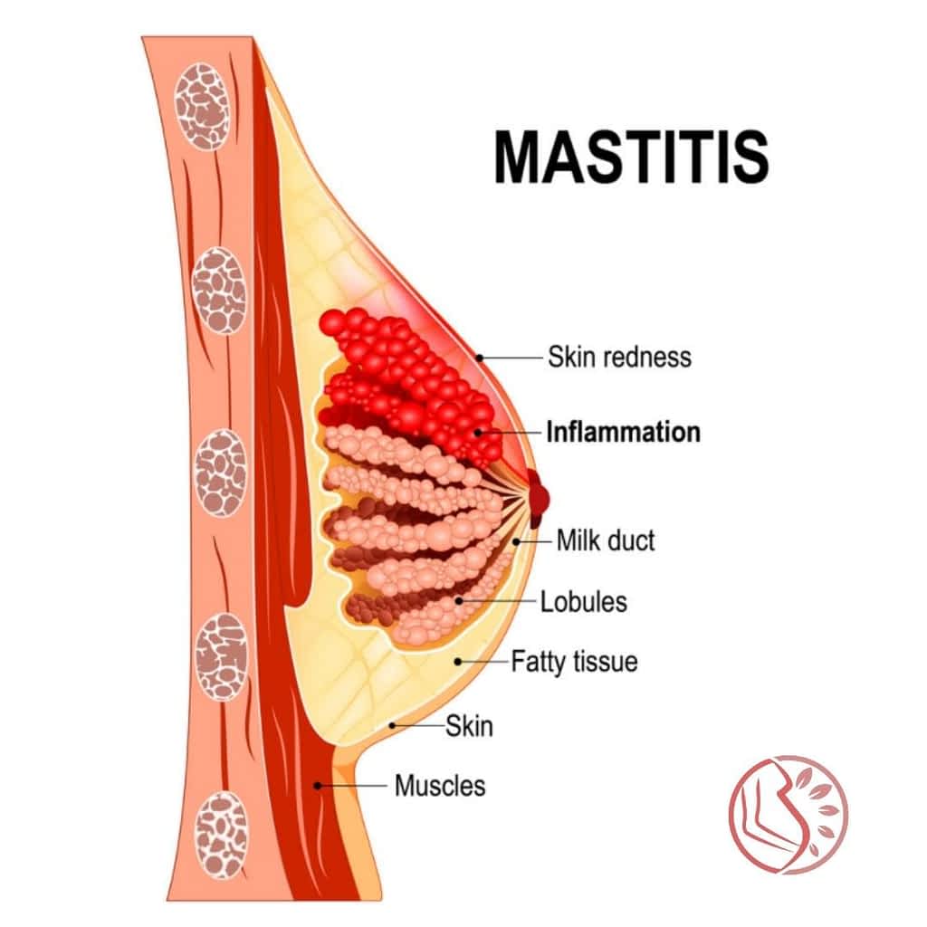 Mastitis - Symptoms And Treatment Options - Breastfeeding - 2021 Mastitis - Symptoms