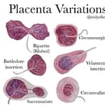 Placenta Variations And Abnormalities - Delivery And Postpartum - 2021 Placenta Variations
Typically The Umbilical Cord Is Inserted In Or Near The Cen...